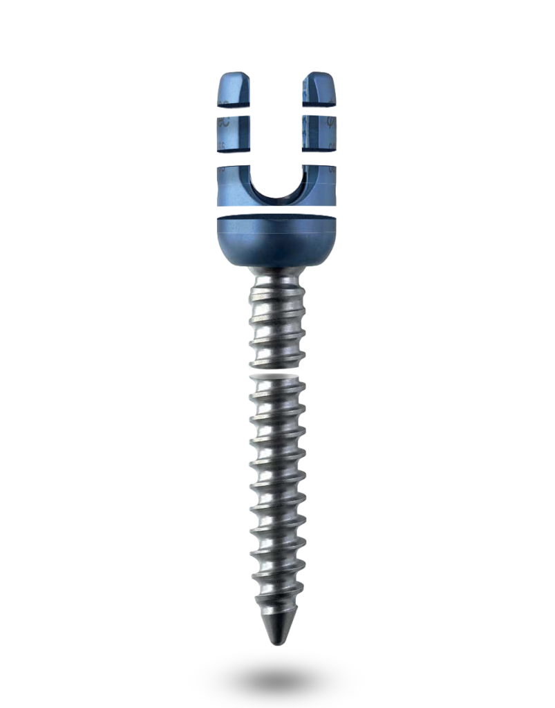 Pedicle screw in pieces - Surgical team celebrating a successful procedure using HUB Healthcare, highlighting care coordination, healthcare communication, integrated healthcare, and patient management software.